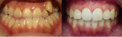 Surgical Underbite