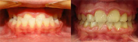 Severe Underbite